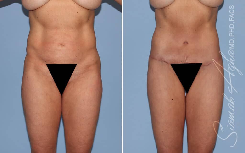 Lower Body Lift Before & After