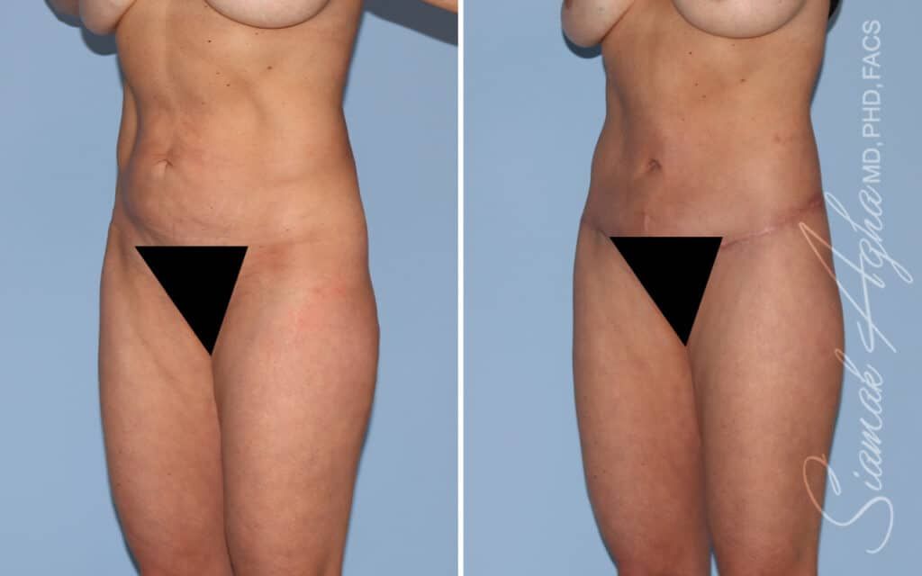 Lower Body Lift Before & After