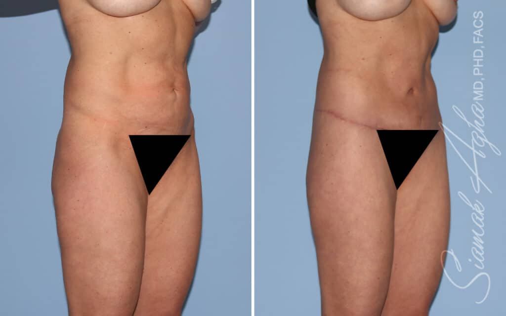 Lower Body Lift Before & After