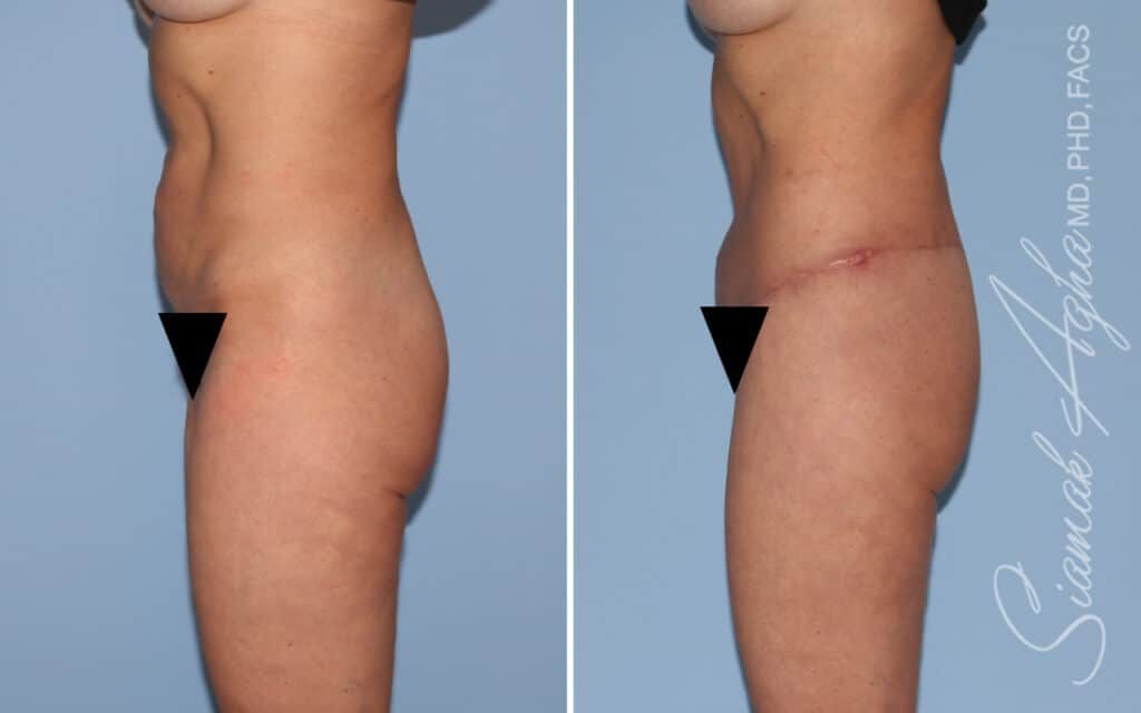 Lower Body Lift Before & After