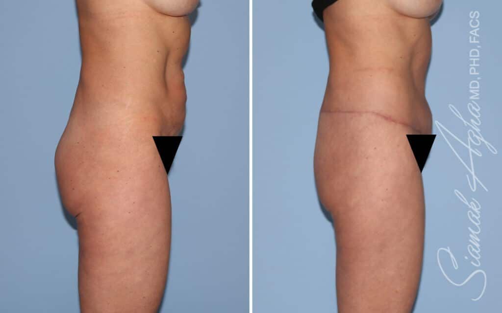 Lower Body Lift Before & After