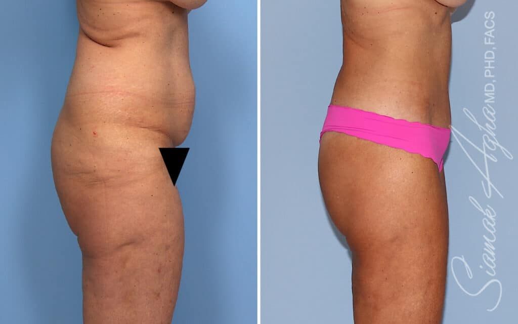 Lower Body Lift Before & After