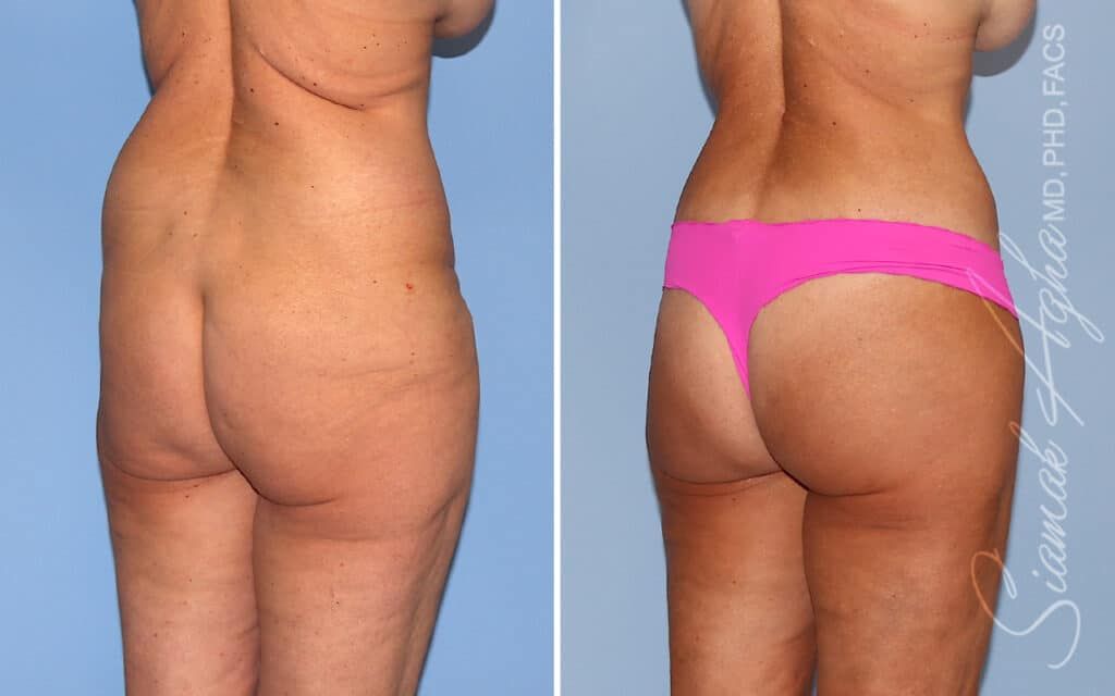 Lower Body Lift Before & After