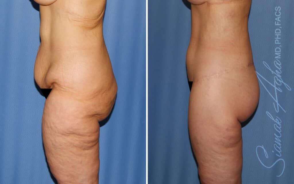 Lower Body Lift Before & After