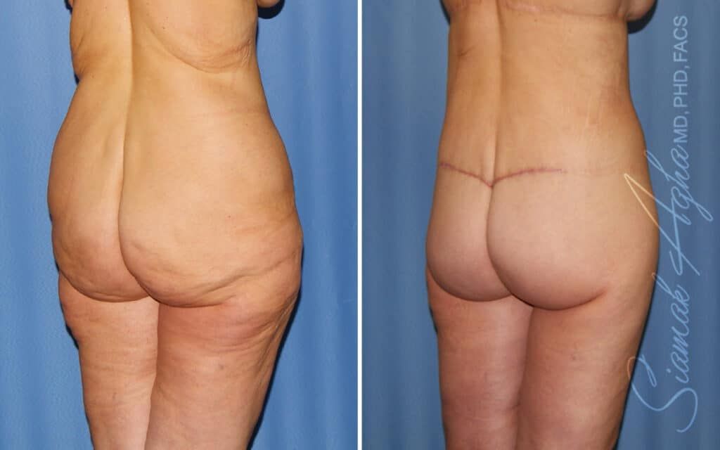 Lower Body Lift Before & After