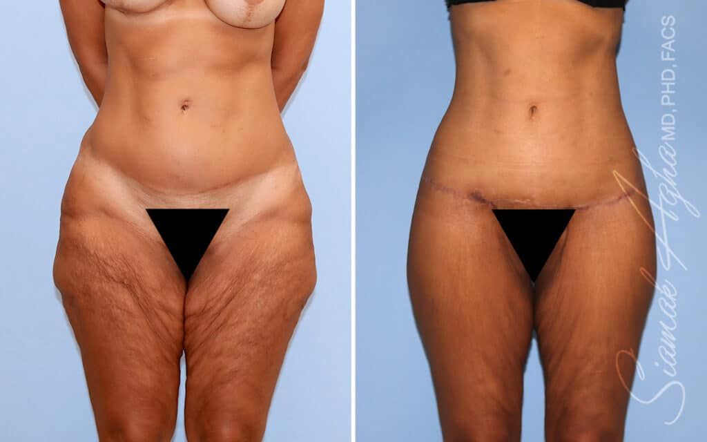 Lower Body Lift Before & After