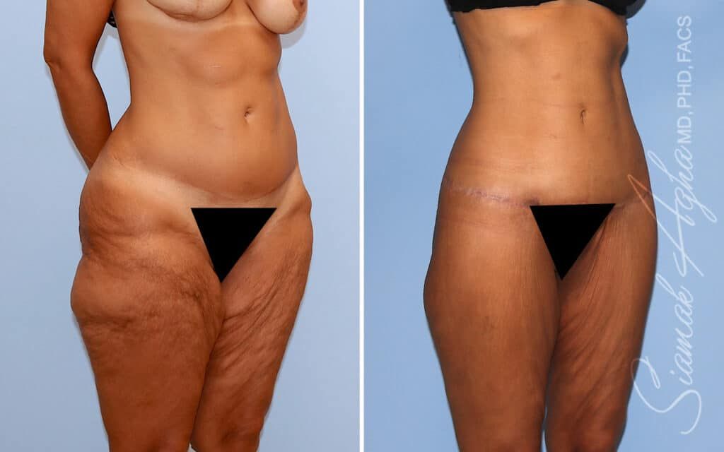 Lower Body Lift Before & After