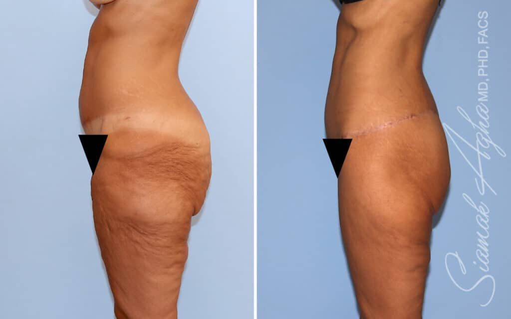Lower Body Lift Before & After