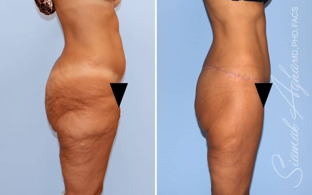 Lower Body Lift Before & After
