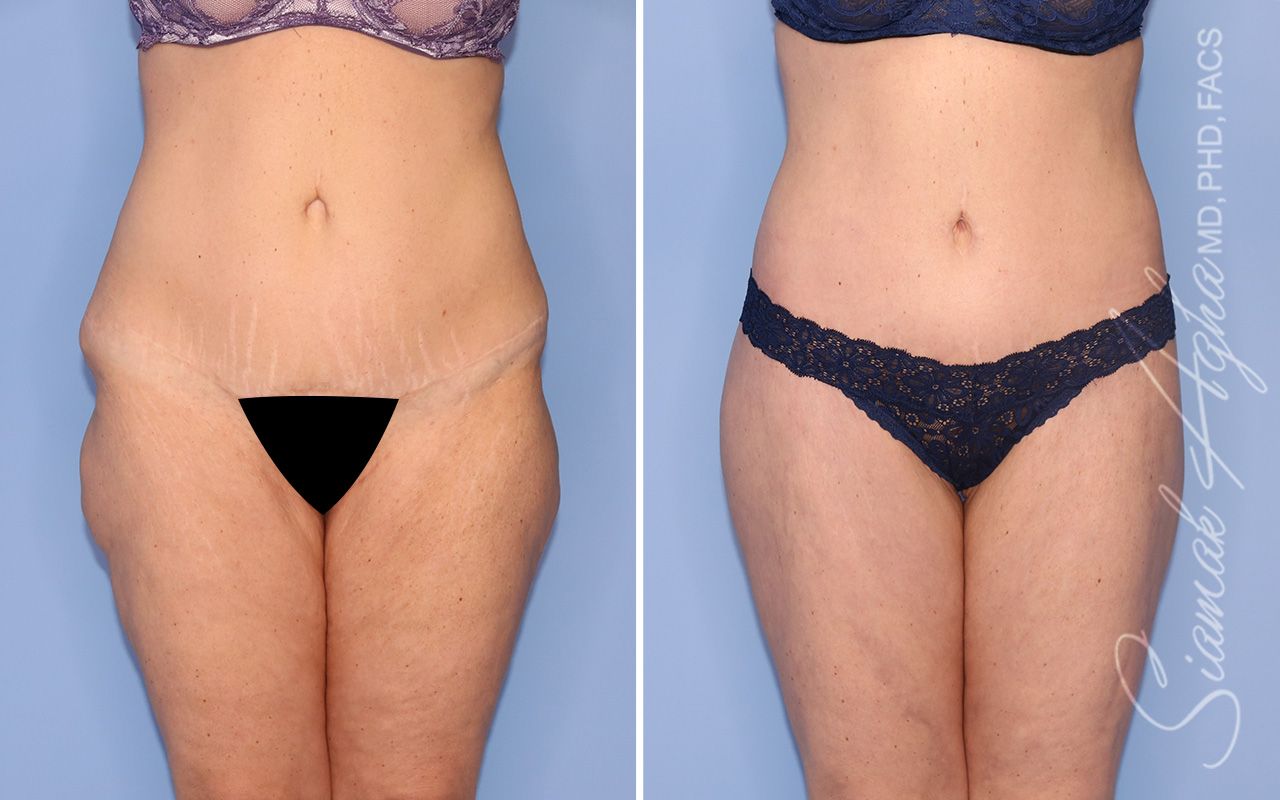 Lower Body Lift Before & After