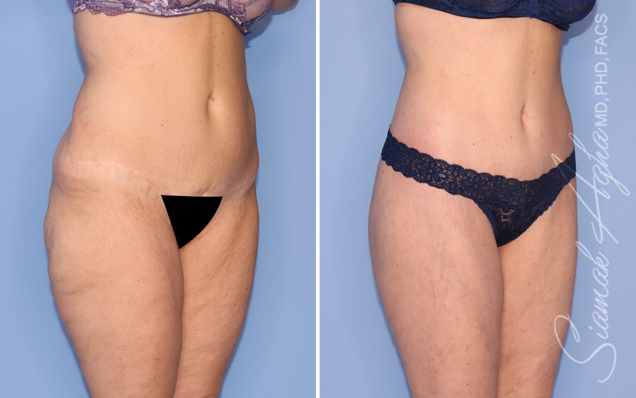 Lower Body Lift Before & After