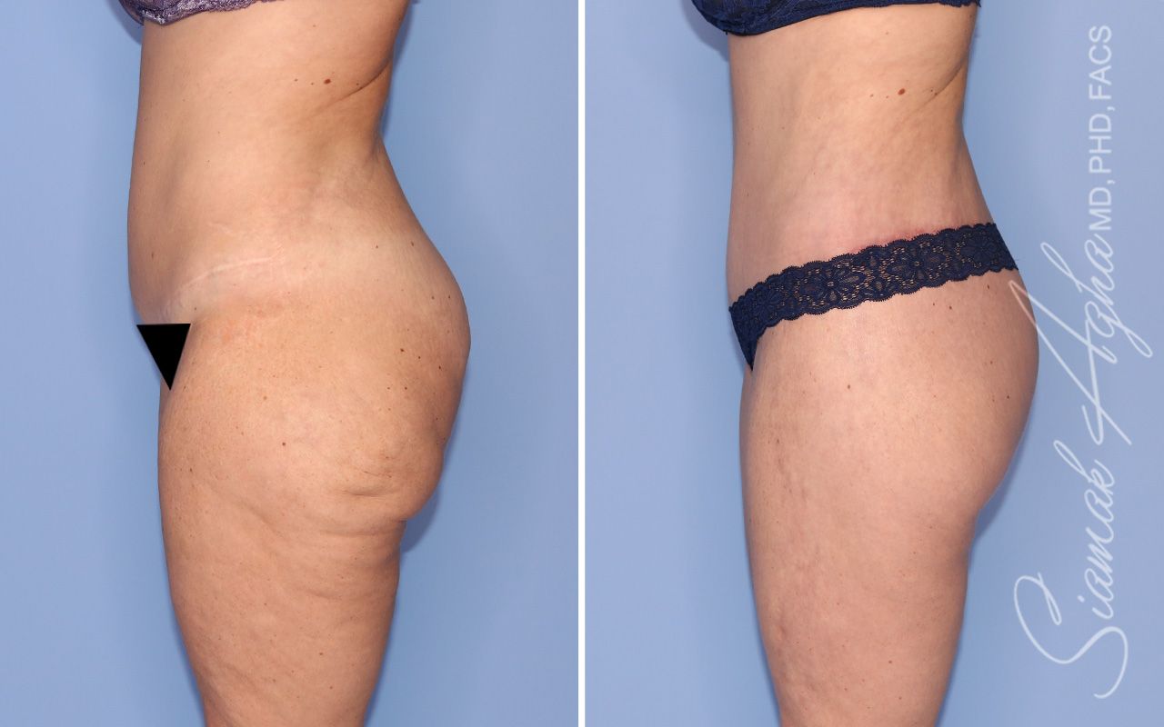 Lower Body Lift Before & After