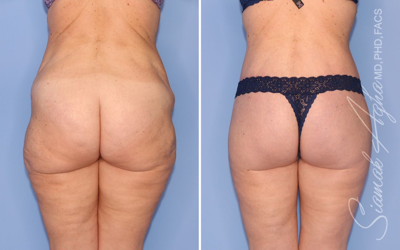 Lower Body Lift Before & After