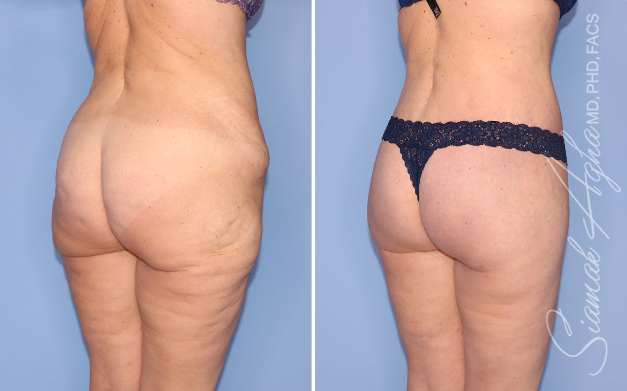 Lower Body Lift Before & After