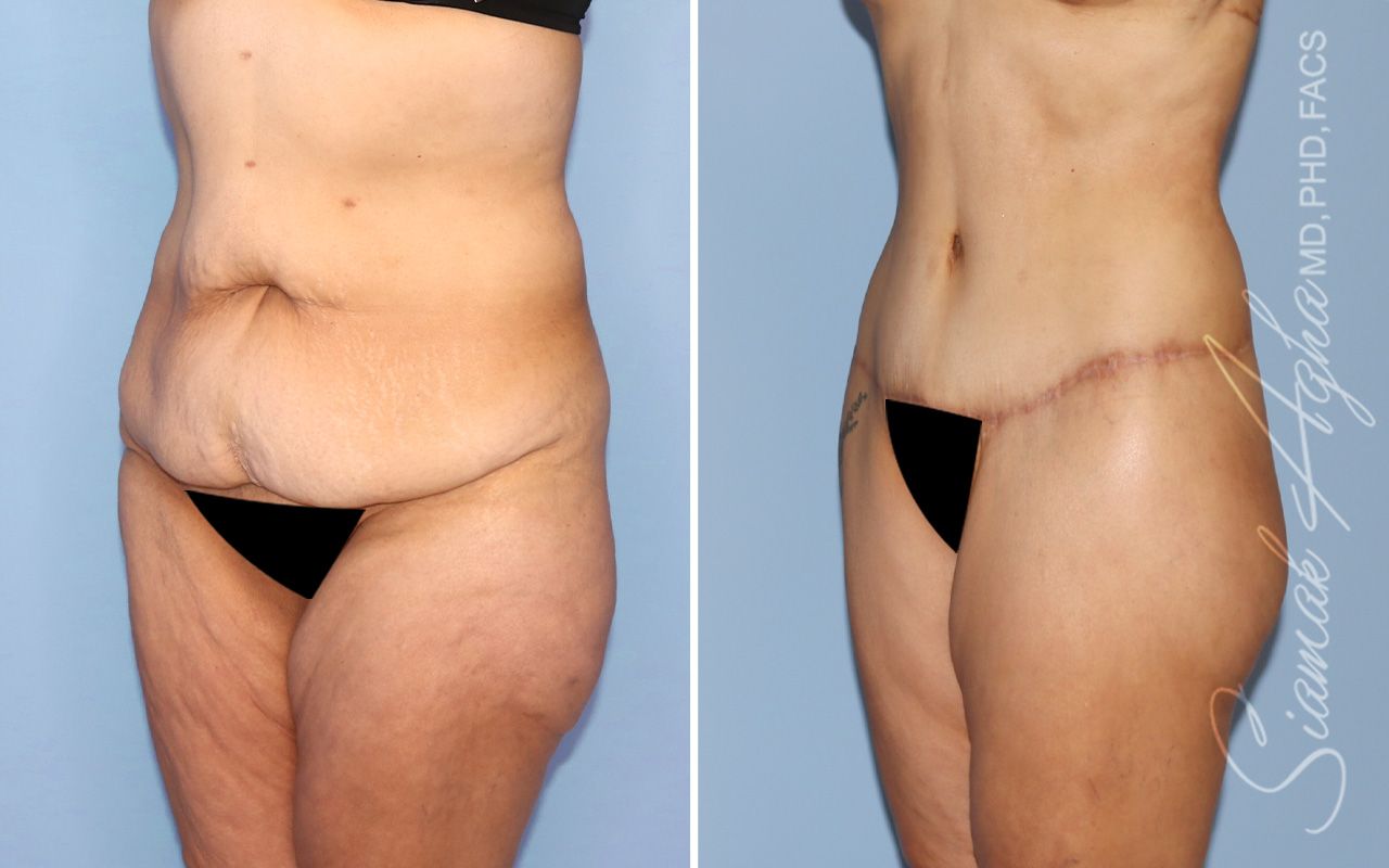 Lower Body Lift Before & After