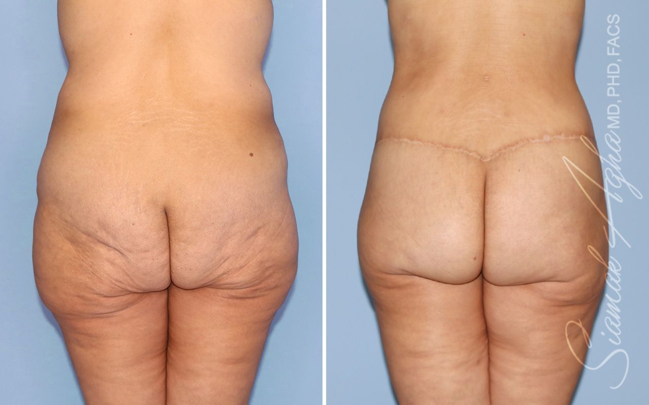 Lower Body Lift Before & After