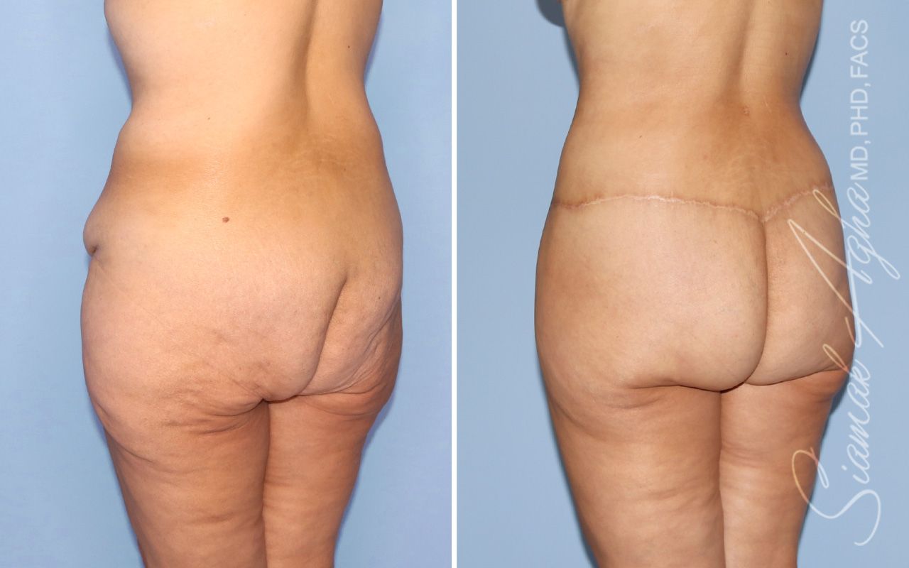 Lower Body Lift Before & After