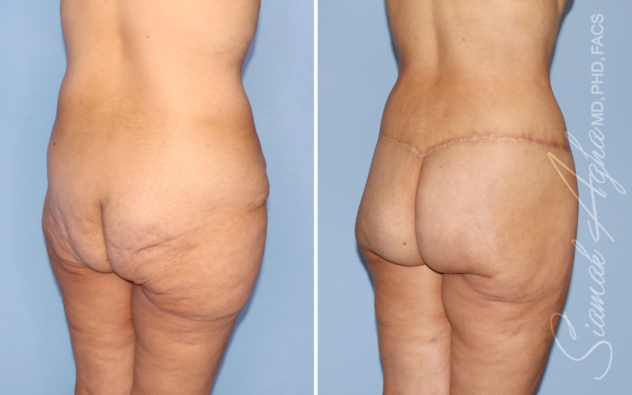 Lower Body Lift Before & After