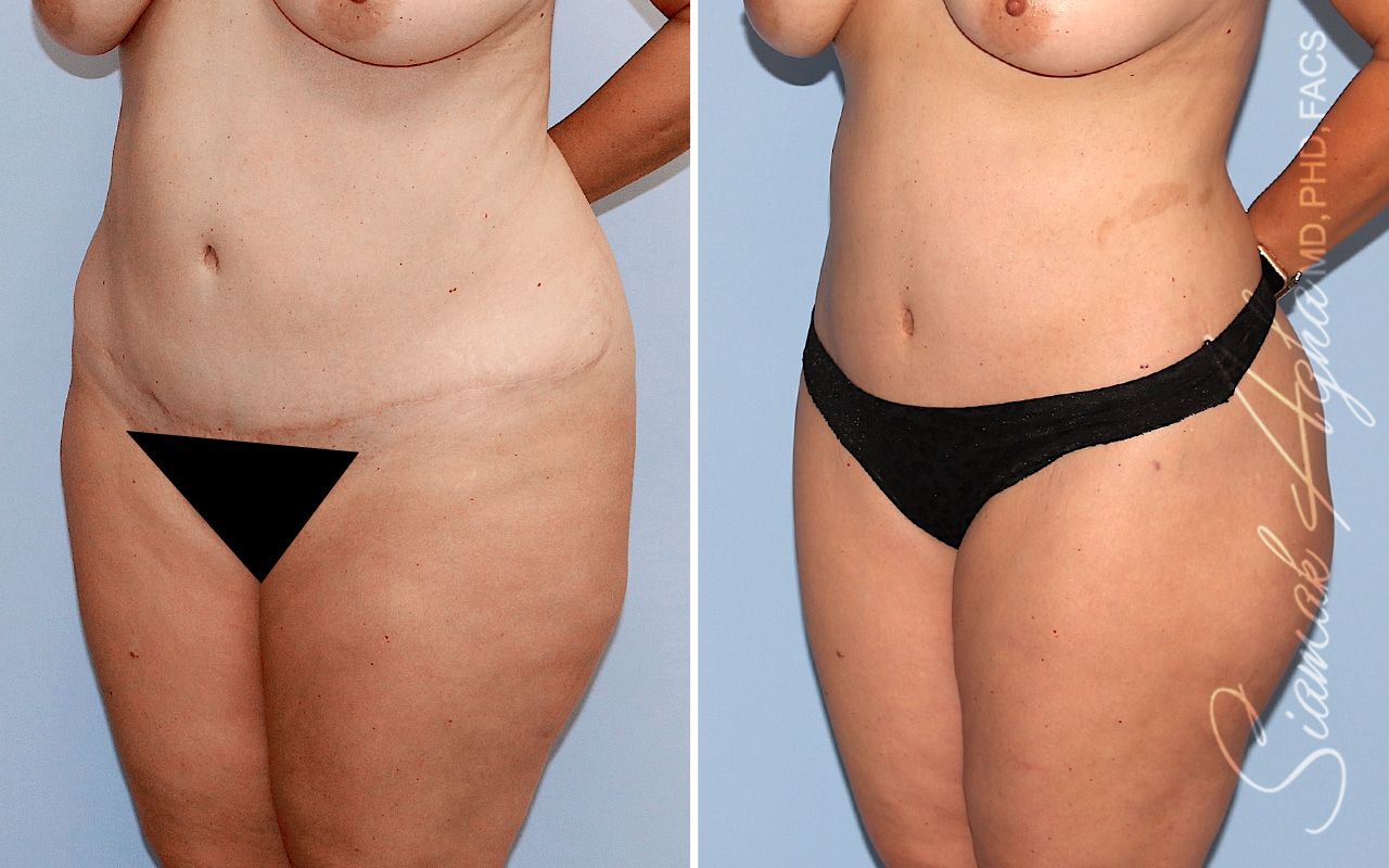 Lower Body Lift Before & After