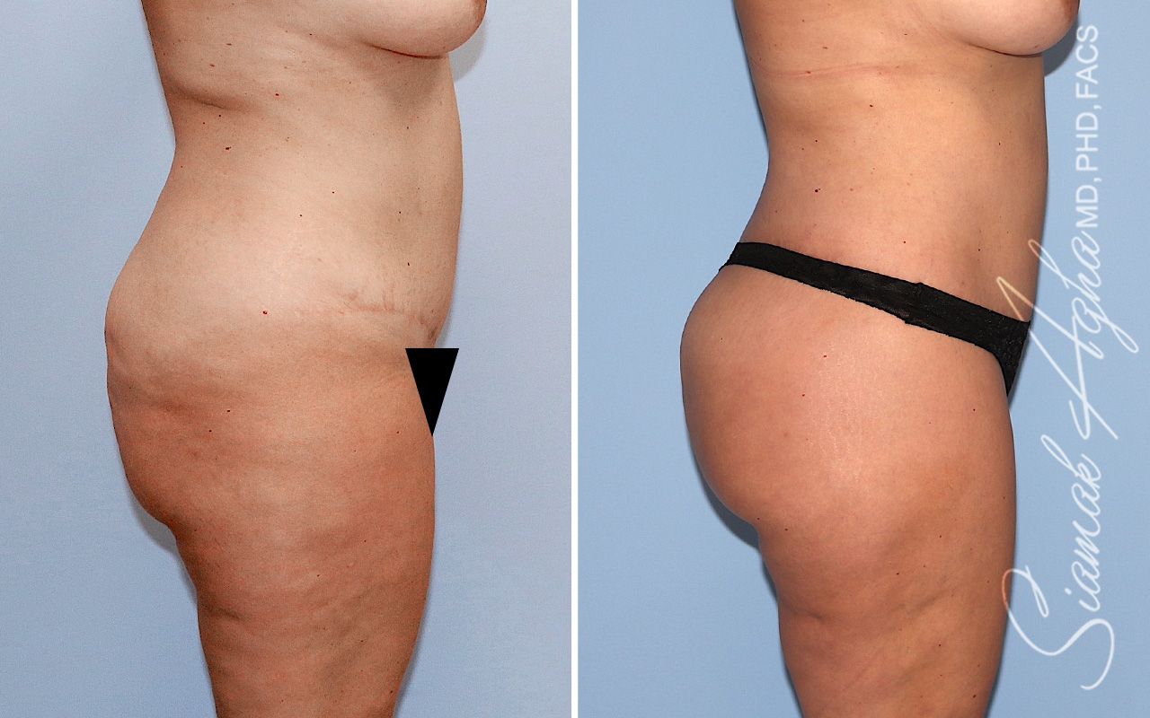 Lower Body Lift Before & After