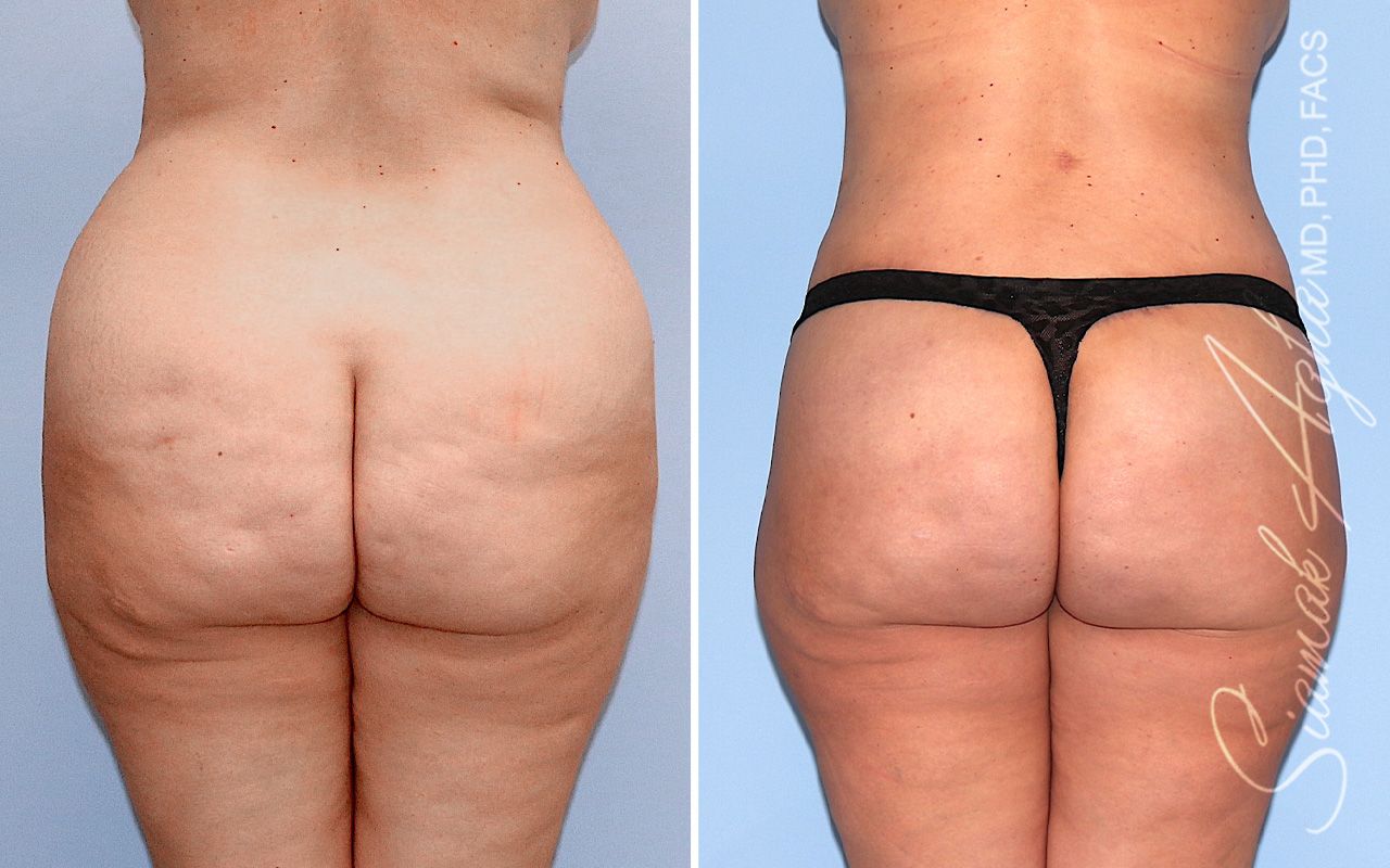 Lower Body Lift Before & After