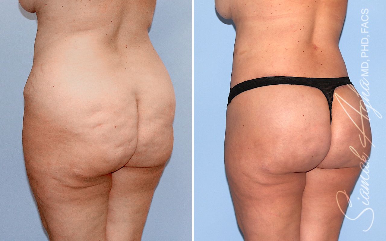 Lower Body Lift Before & After