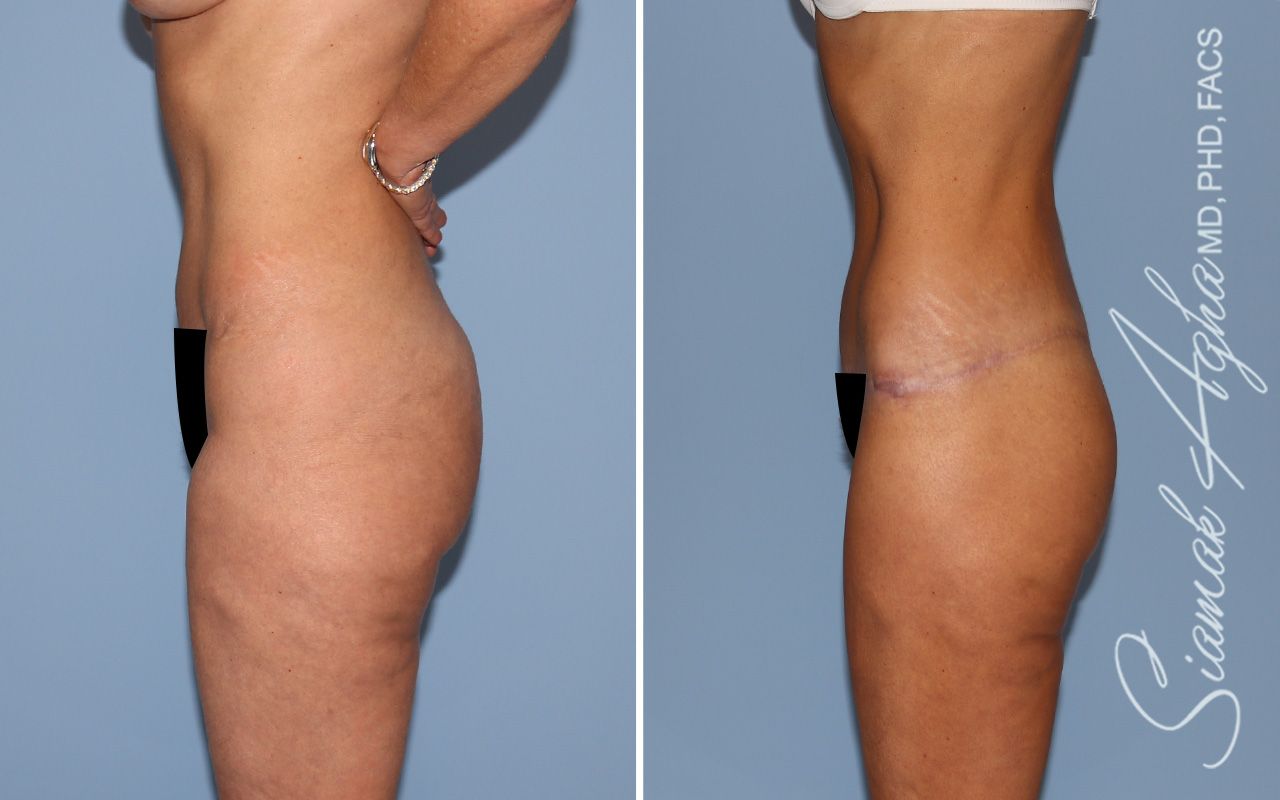 Lower Body Lift Before & After