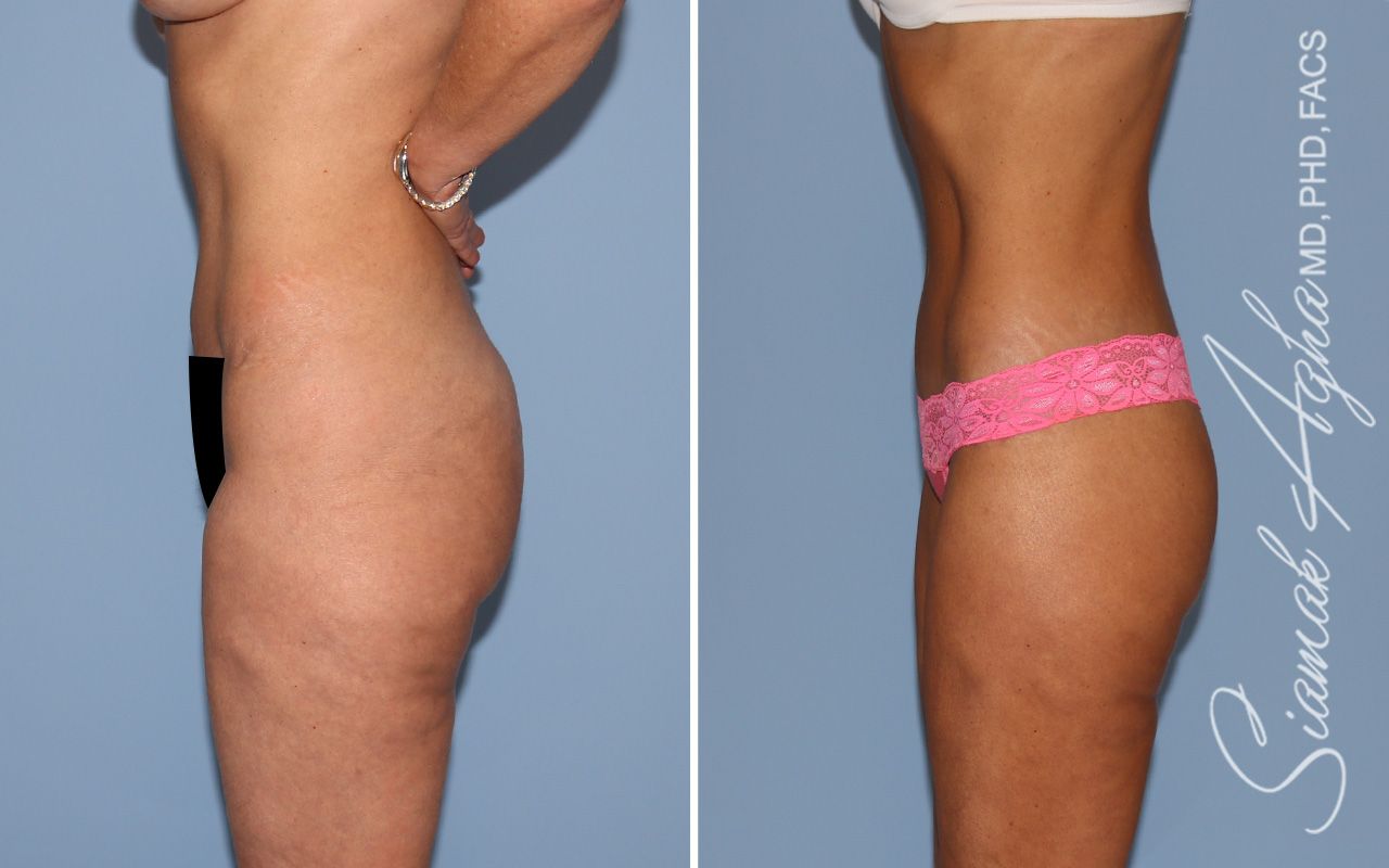Lower Body Lift Before & After