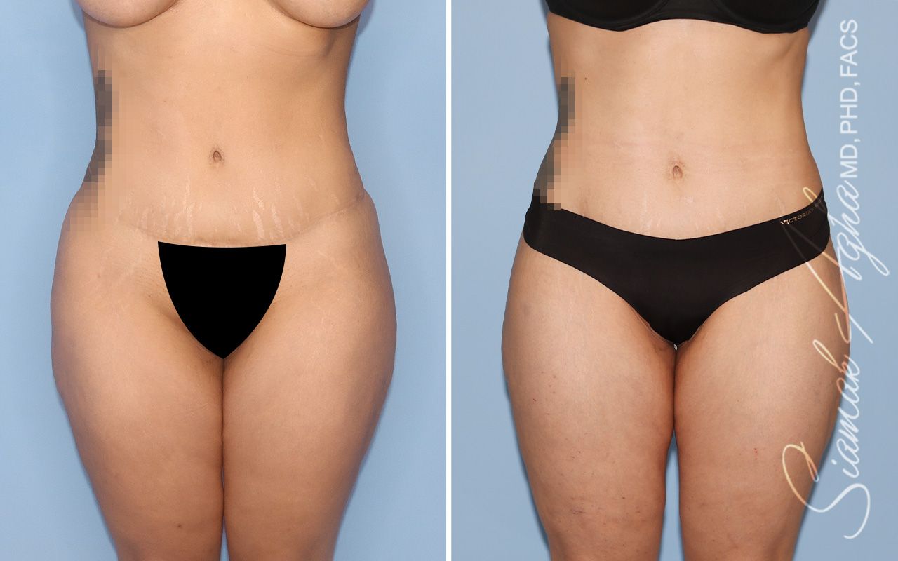 Lower Body Lift Before & After