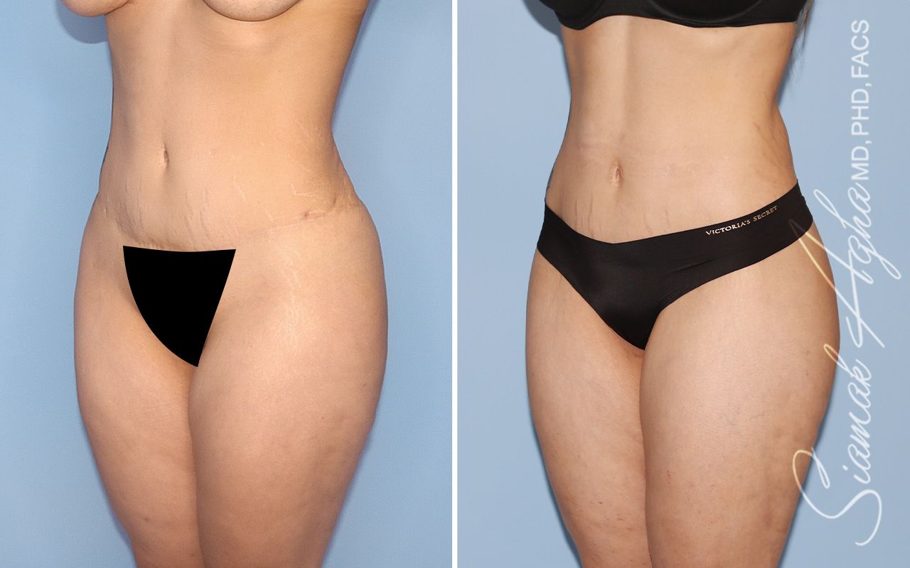 Lower Body Lift Before & After