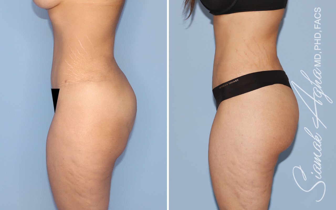 Lower Body Lift Before & After