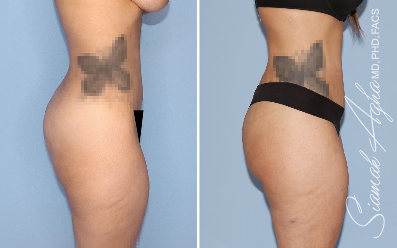 Lower Body Lift Before & After