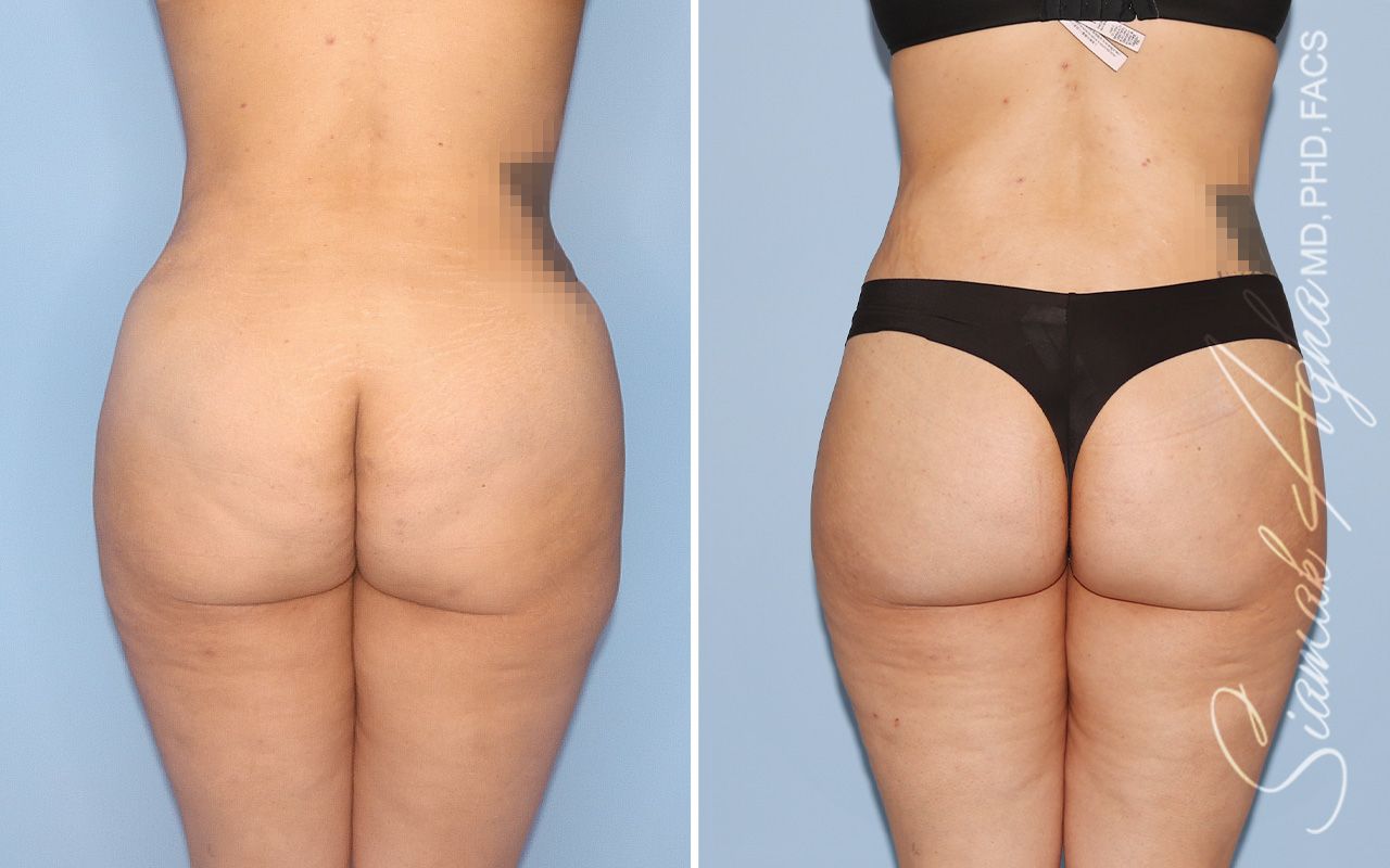 Lower Body Lift Before & After