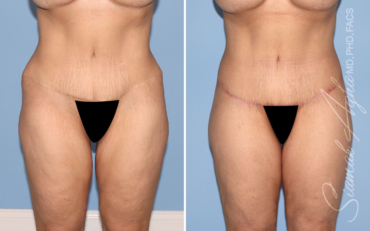 Lower Body Lift Before & After