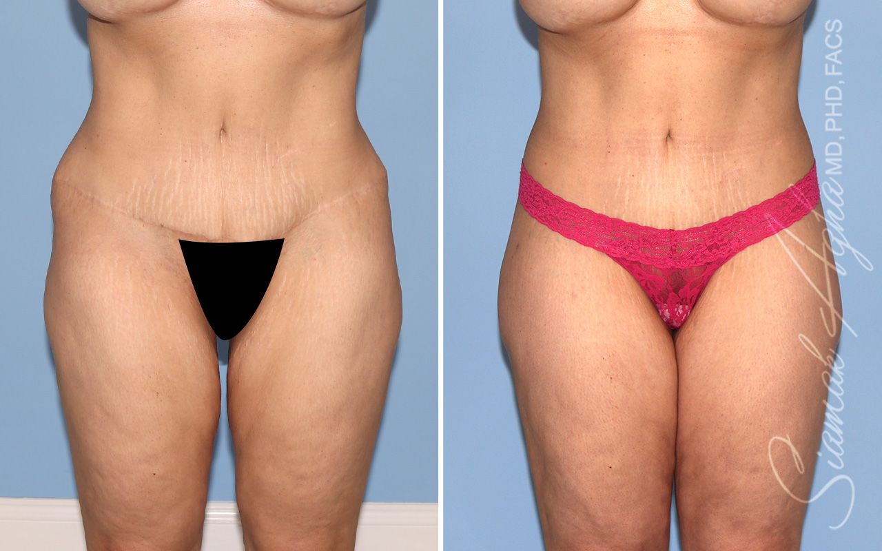 Lower Body Lift Before & After