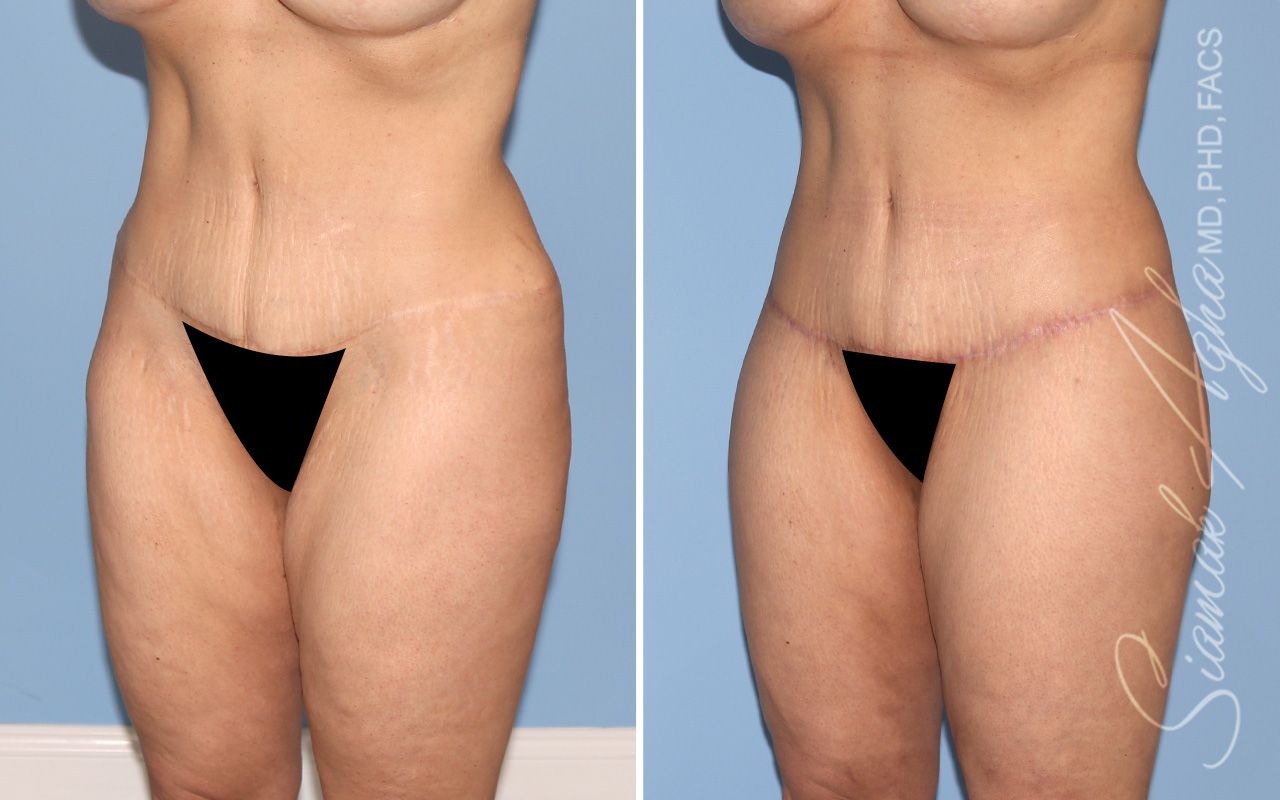 Lower Body Lift Before & After