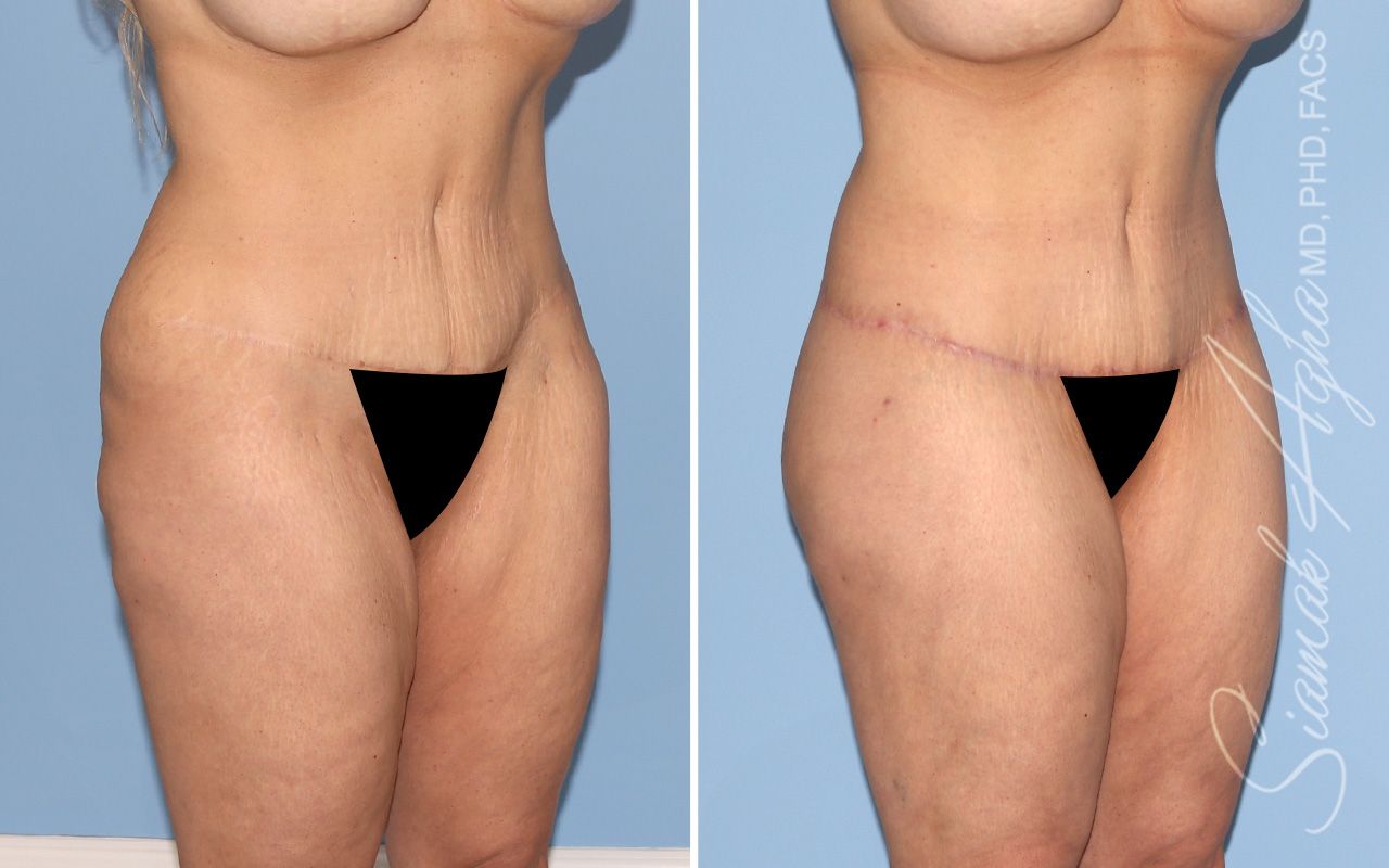 Lower Body Lift Before & After