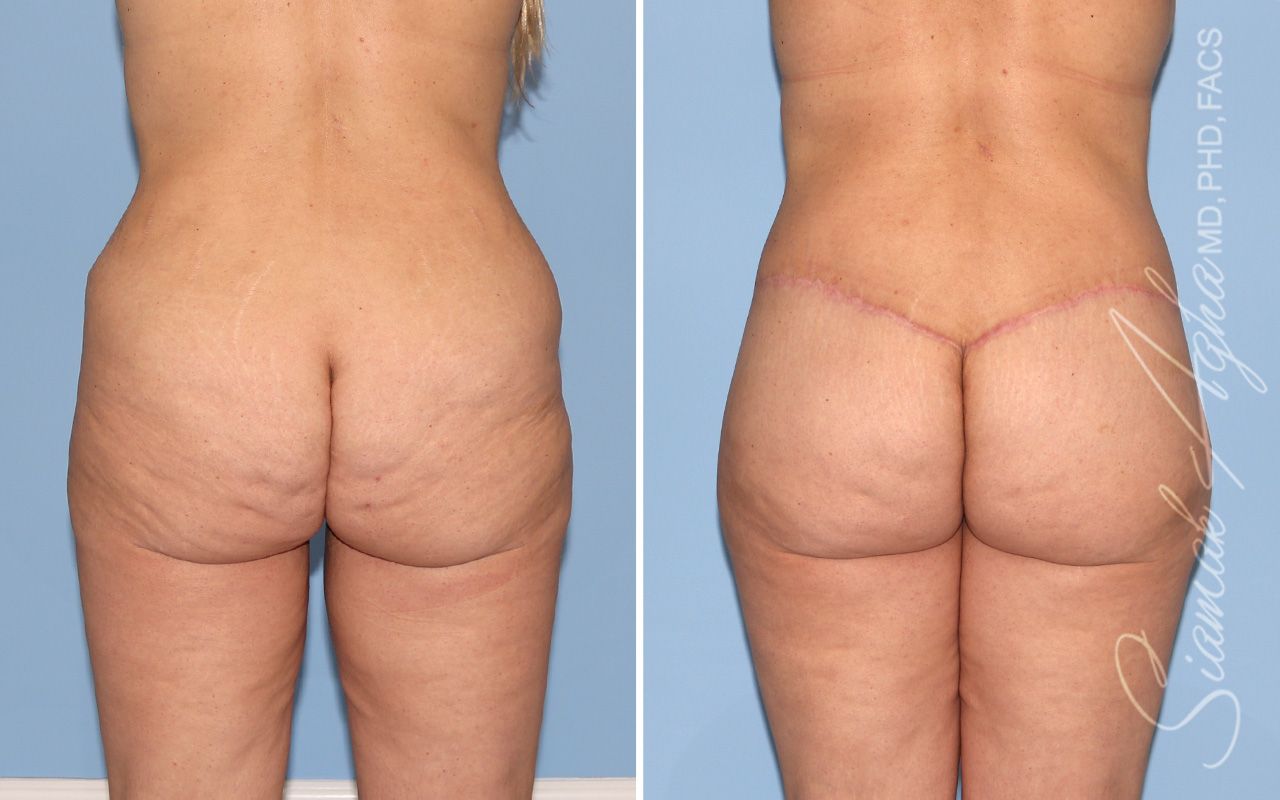 Lower Body Lift Before & After