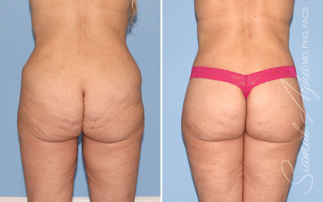 Lower Body Lift Before & After