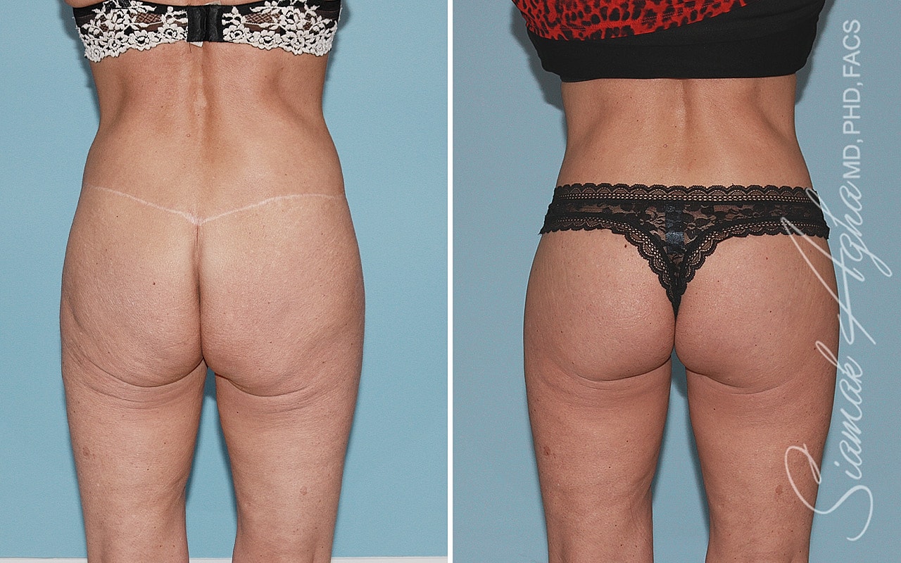 High-Definition Lower Body Lift™ Before & After