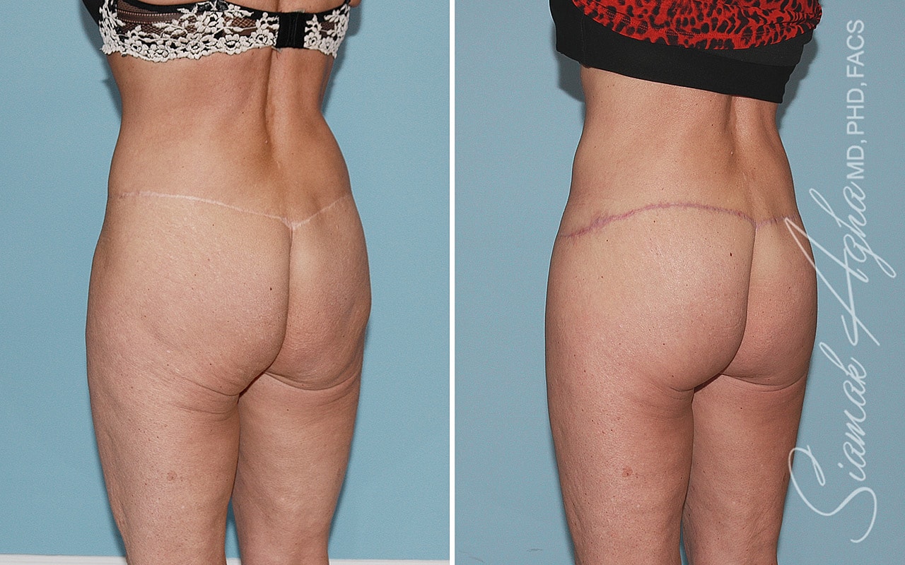 High-Definition Lower Body Lift™ Before & After