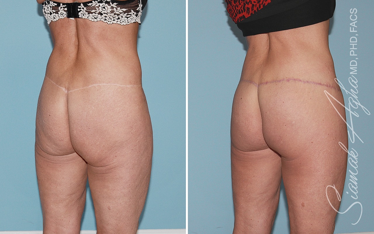 High-Definition Lower Body Lift™ Before & After