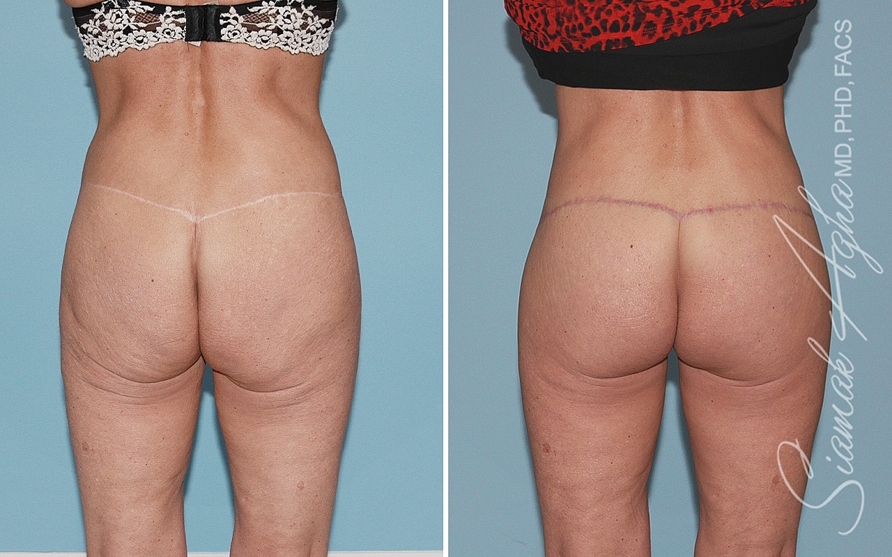 High-Definition Lower Body Lift™ Before & After