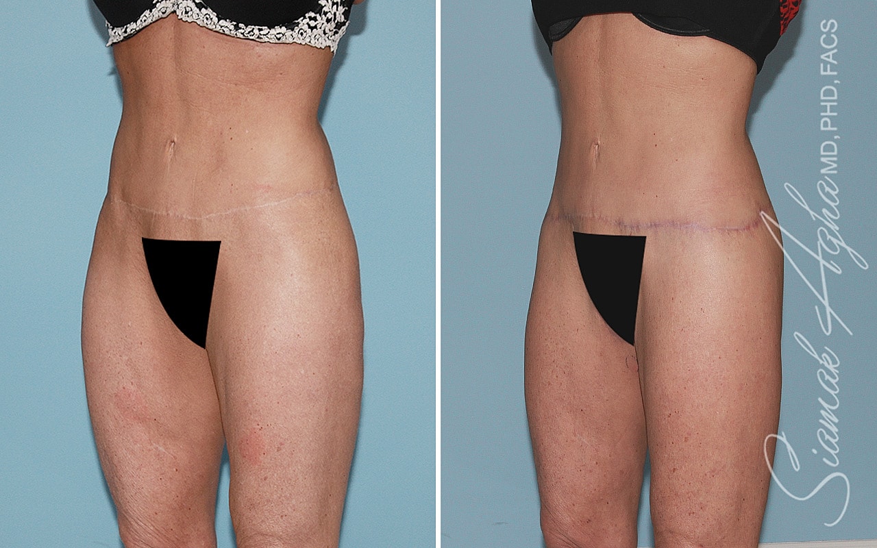 High-Definition Lower Body Lift™ Before & After