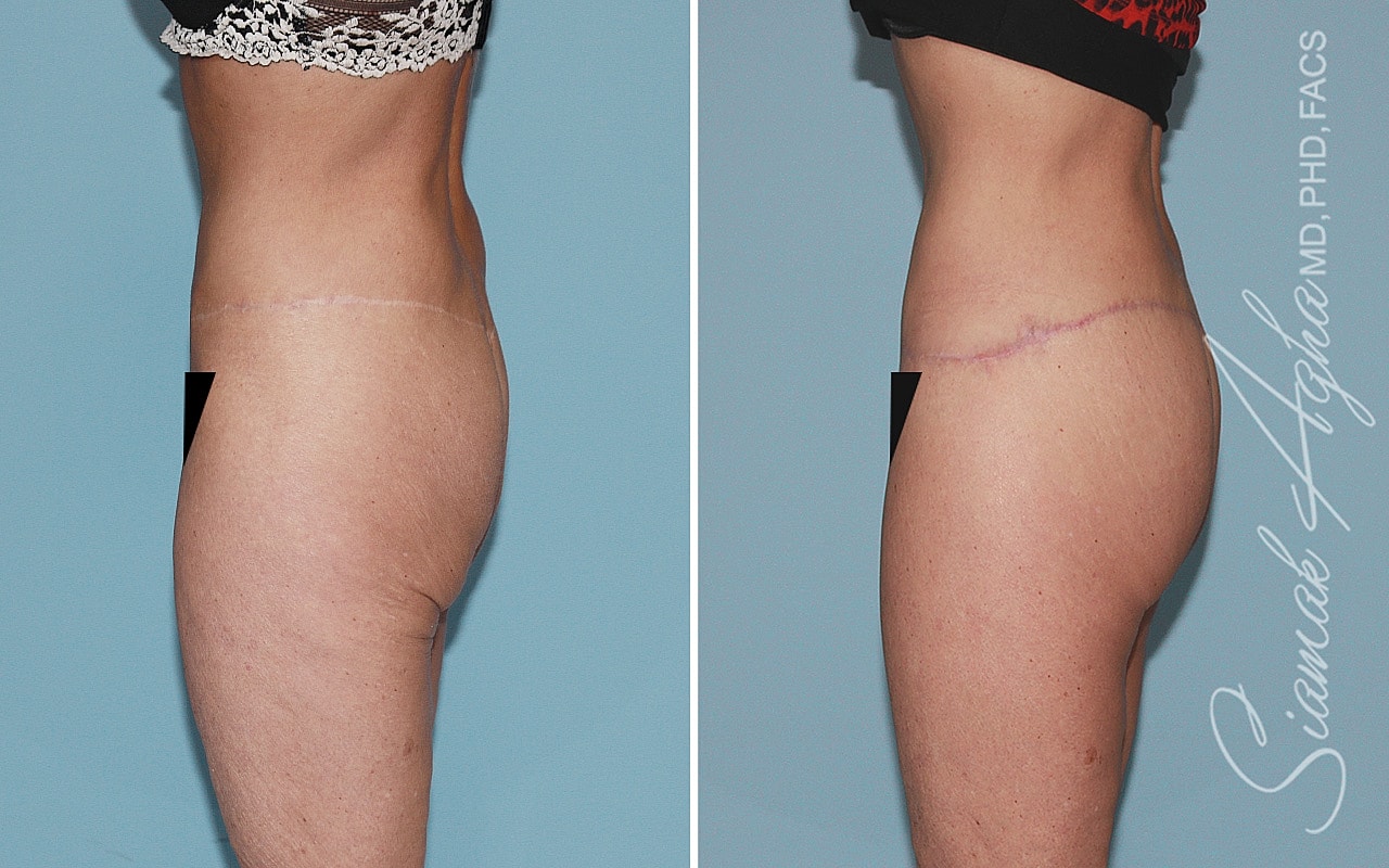 High-Definition Lower Body Lift™ Before & After