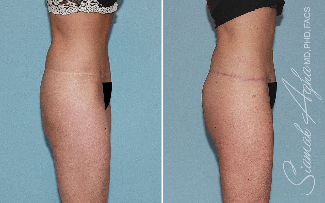 High-Definition Lower Body Lift™ Before & After
