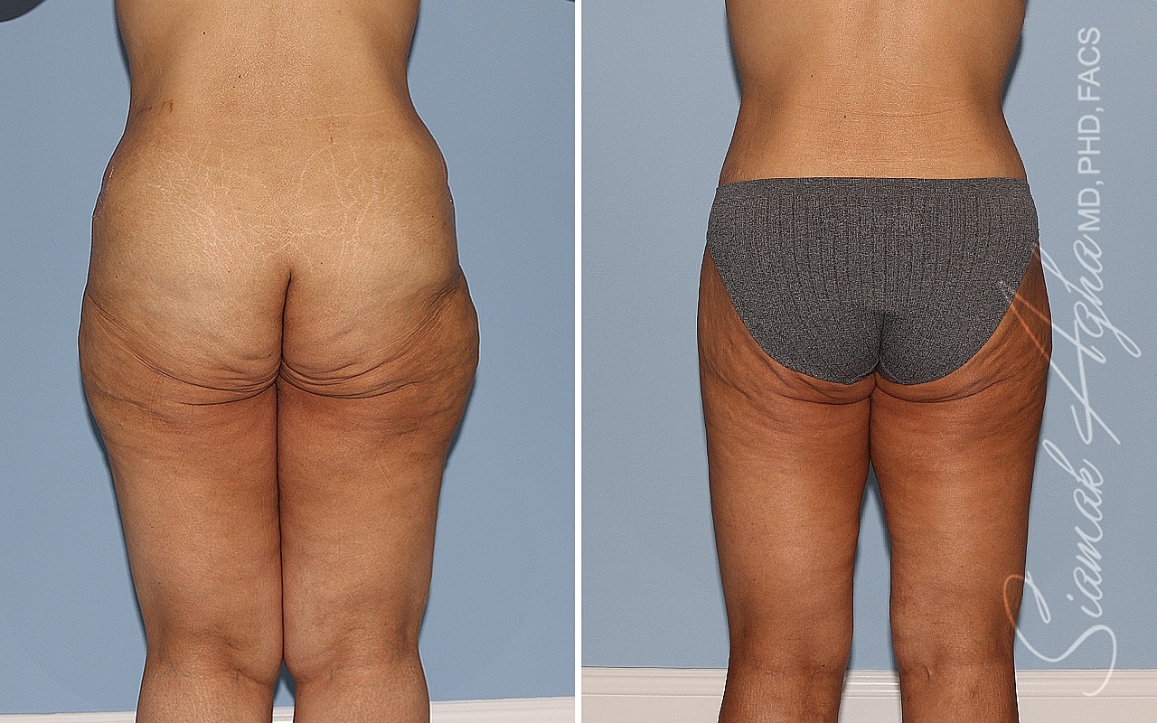 High-Definition Lower Body Lift™ Before & After