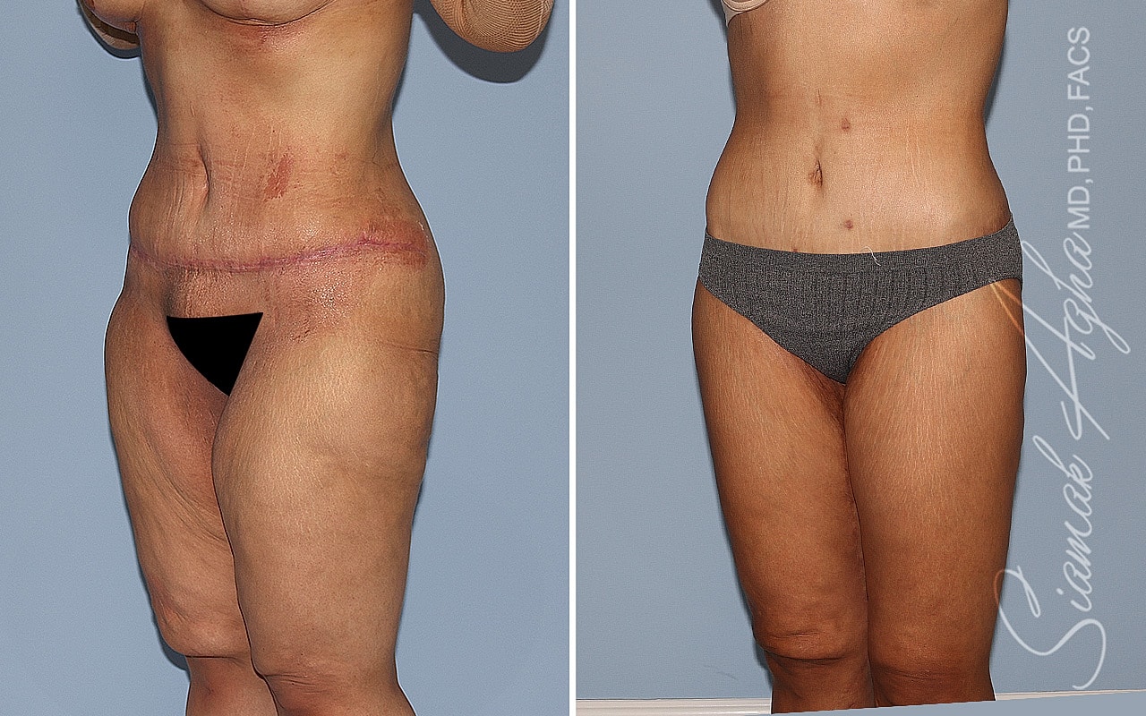 High-Definition Lower Body Lift™ Before & After