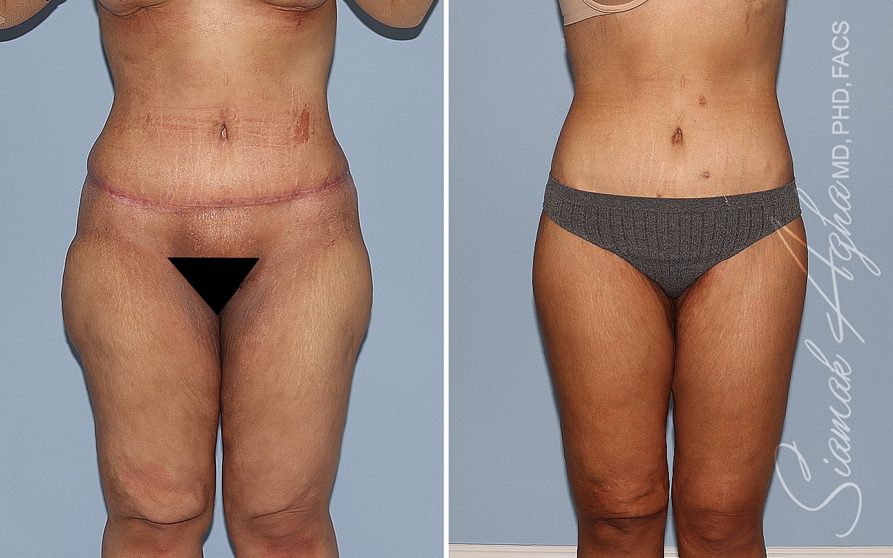 High-Definition Lower Body Lift™ Before & After