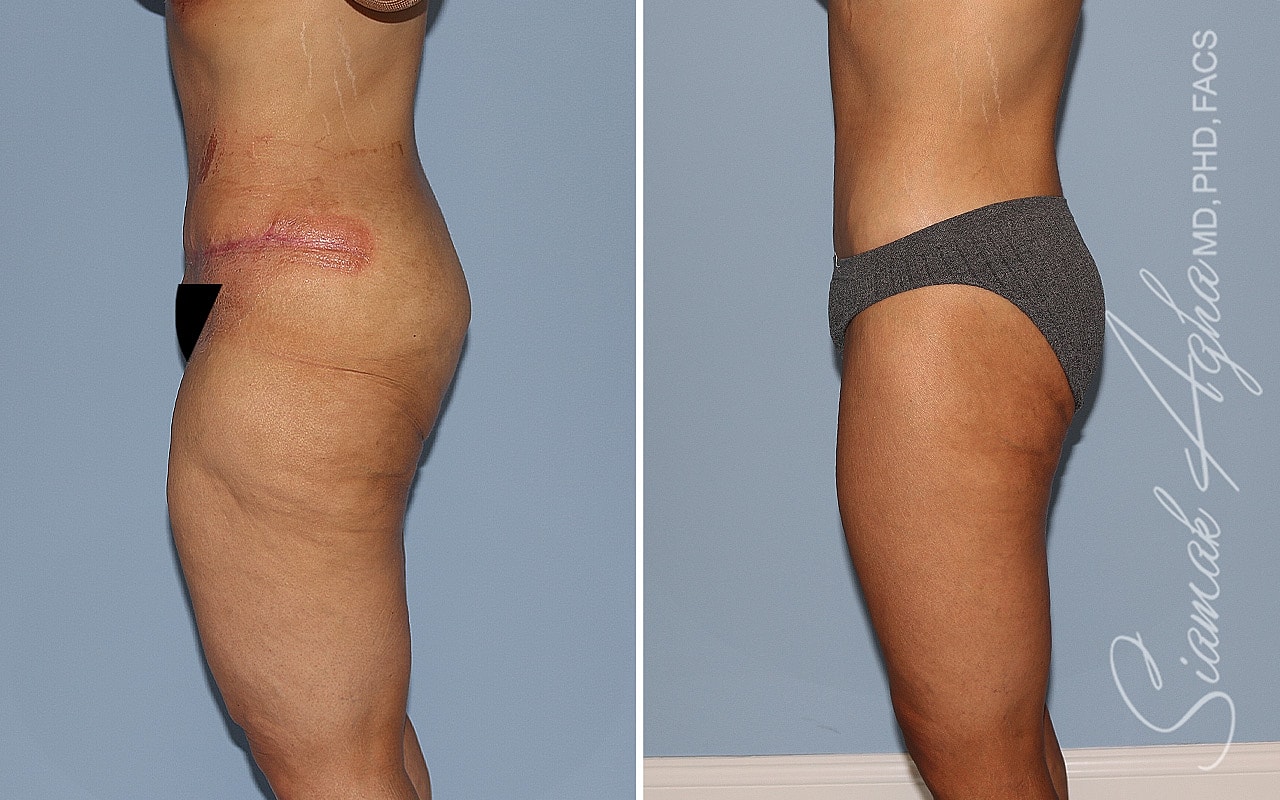 High-Definition Lower Body Lift™ Before & After